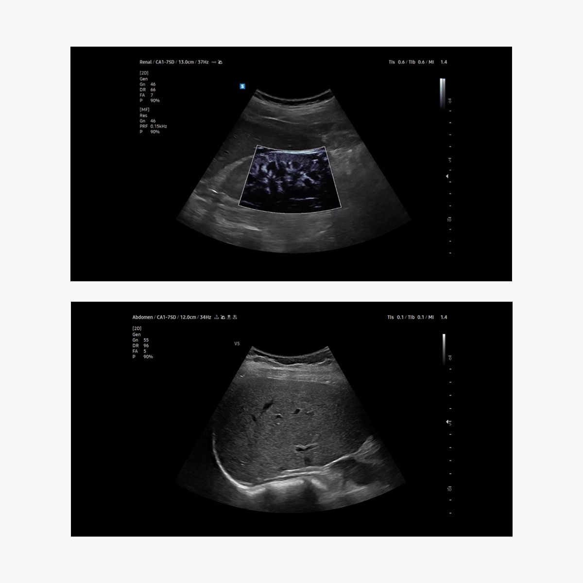 V5 – Ultrasonido ginecológico de precisión accesible