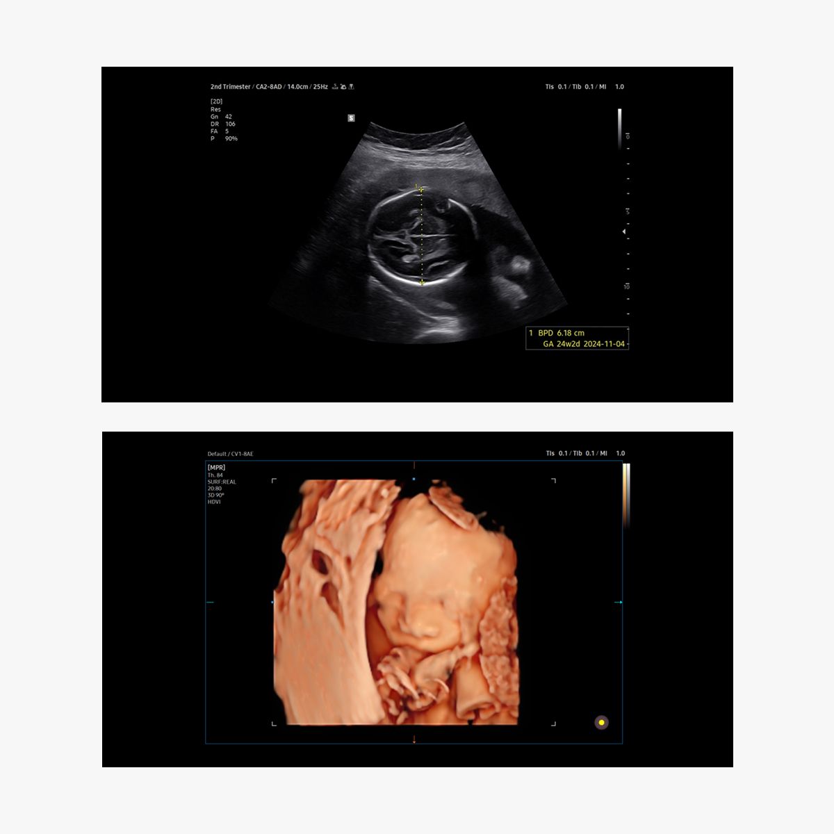 V5 – Ultrasonido ginecológico de precisión accesible